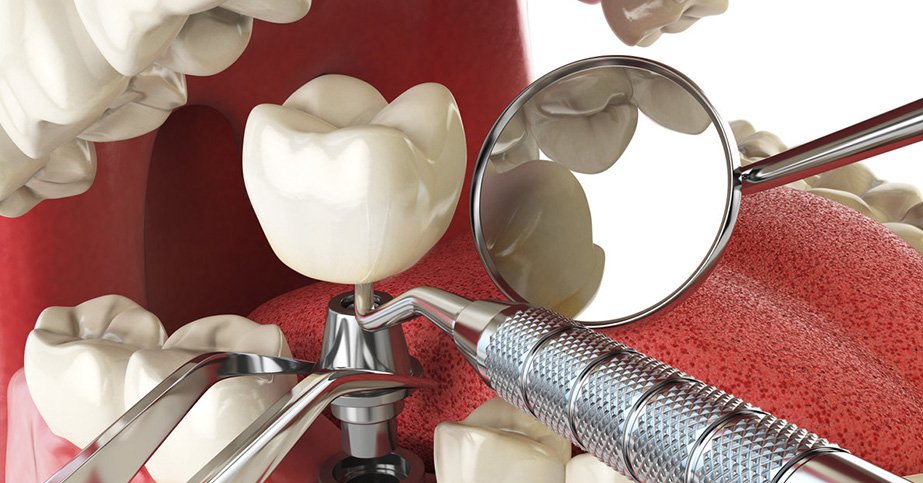 Dental implants