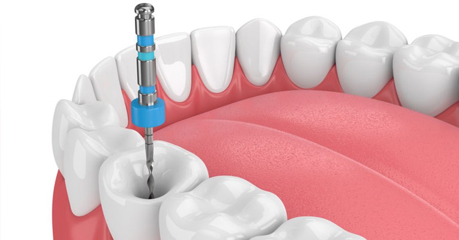 Root canal treatment